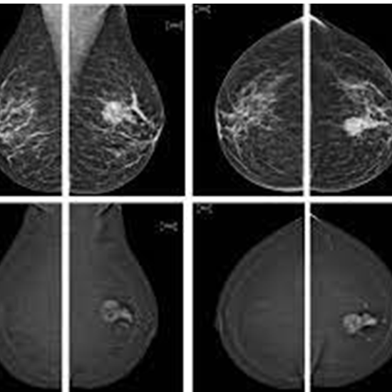 MRI Right Breast